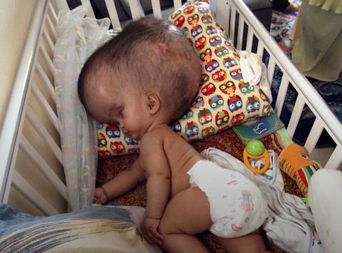 '수두증'으로 일찍 세상 떠난 말레이 아기[연합뉴스제공]
