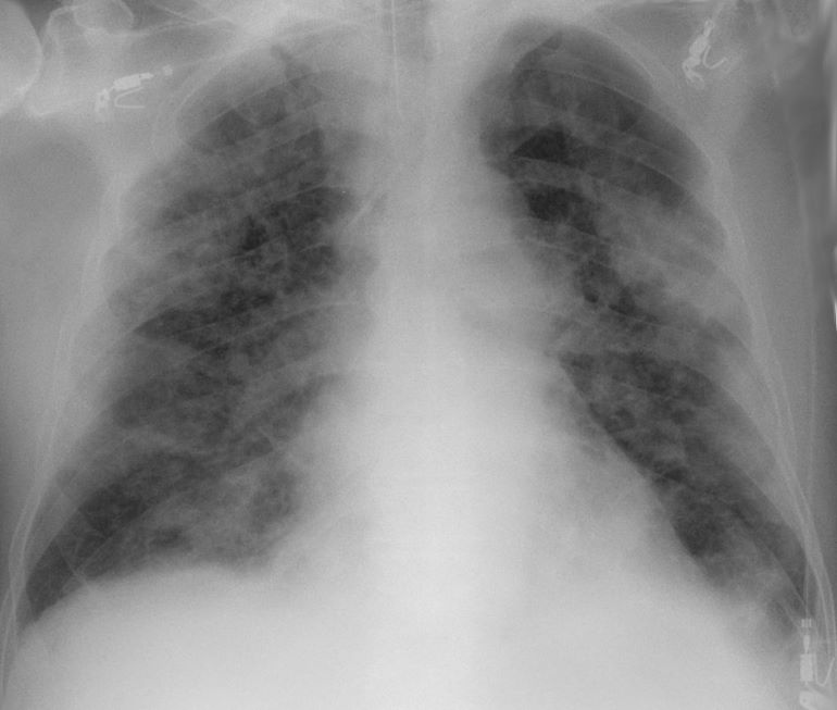 코로나19에 감염된 환자의 폐 엑스레이 [자료제공/위키피디아]